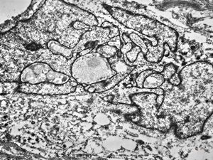 M,10y. | leiomyosarcoma